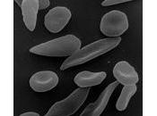 Células para tratar anemia falciforme