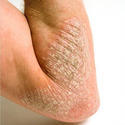 psoriasis Disminución de la función del colesterol HDL en pacientes con psoriasis