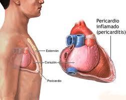  Cardiopatía isquémica