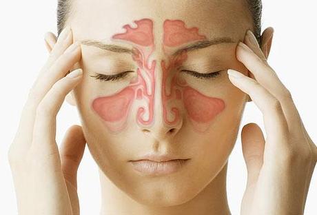 sinusitis1 ¿Cómo tratar la sinusitis?