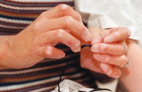 esclerodermia ¿Que son las esclerodermias?