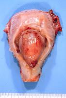 Nuevo Tratamiento Farmacológico de los Fibromas Uterinos