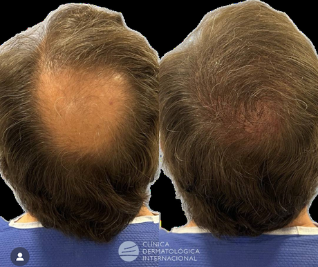 Trasplante capilar sin rasurado