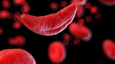 Desarrollan un tratamiento nuevo para la anemia falciforme Desarrollan un tratamiento nuevo para la anemia falciforme