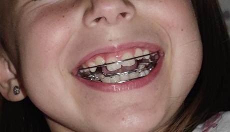 Experiencia: le ponen a mi hija aparato con 7 años Experiencia: le ponen a mi hija aparato con 7 años