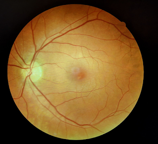 Edema macular.