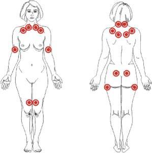 fibromialgia fibromialgia Fibromialgia: tratamiento