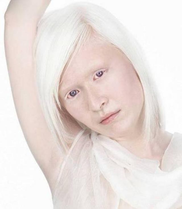 Albinismo1 Características y causas del albinismo