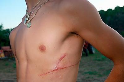 Los falsos mitos en el cuidado de las cicatrices