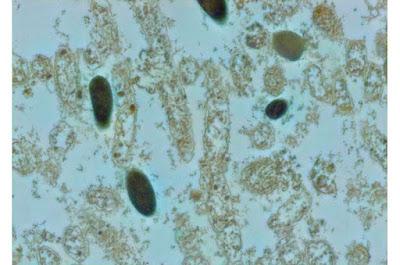 Como restaurar las bacterias vaginales luego de una infección Como restaurar las bacterias vaginales luego de una infección