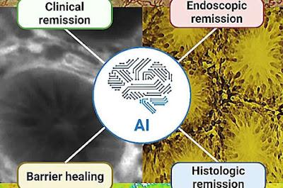 Tratamiento preciso de la enfermedad inflamatoria intestinal Tratamiento preciso de la enfermedad inflamatoria intestinal