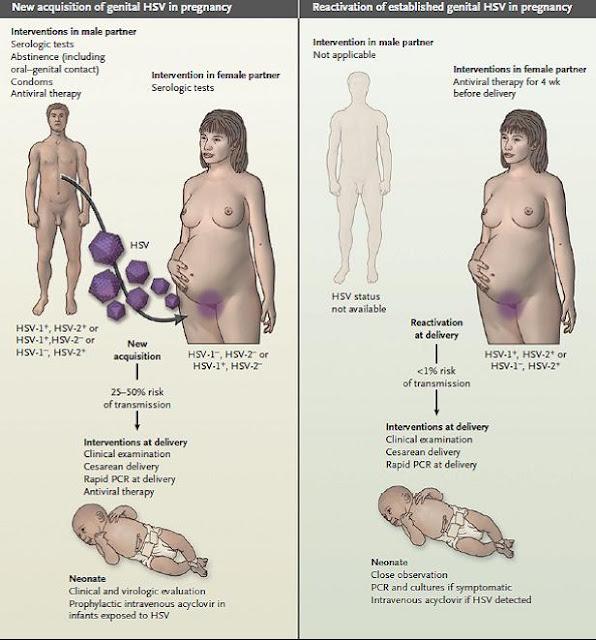 Revisión sobre virus del herpes materno y neonatal