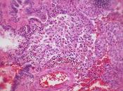 Bronquiolitis