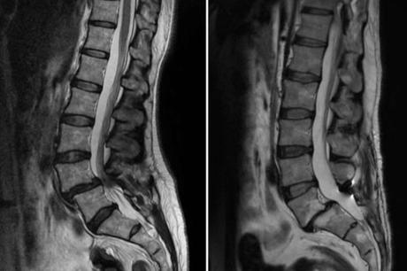 El Dr. Botella-Asunción habla sobre la Espondilolistesis Lumbar