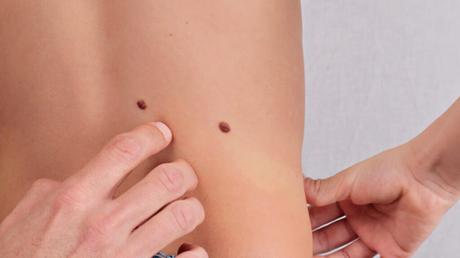 Cuidados y revisión de los lunares en los peques