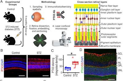 Encuentran un factor desencadenante de la Retinopatía Diabetica