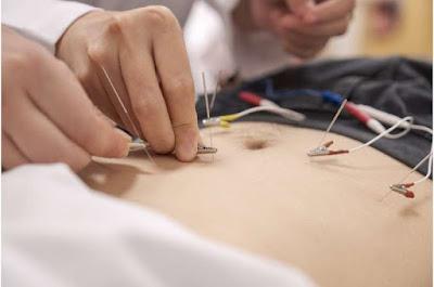 La electroacupuntura podría ayudar a controlar la obesidad La electroacupuntura podría ayudar a controlar la obesidad