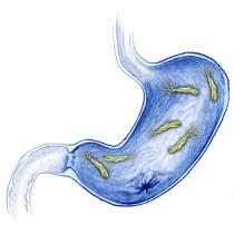 Helicobacter pylori (H. pylori) el sigiloso enemigo que pasa desapercibido Helicobacter pylori (H. pylori) el sigiloso enemigo que pasa desapercibido