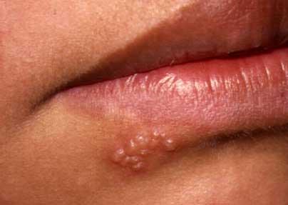 herpes labial Se halla un gen relacionado con el herpes labial