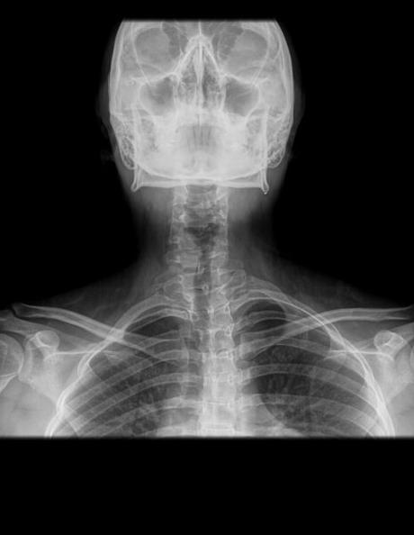 paciente trago un hueso de pollo