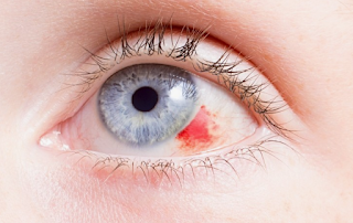Hemorragia subconjuntival.