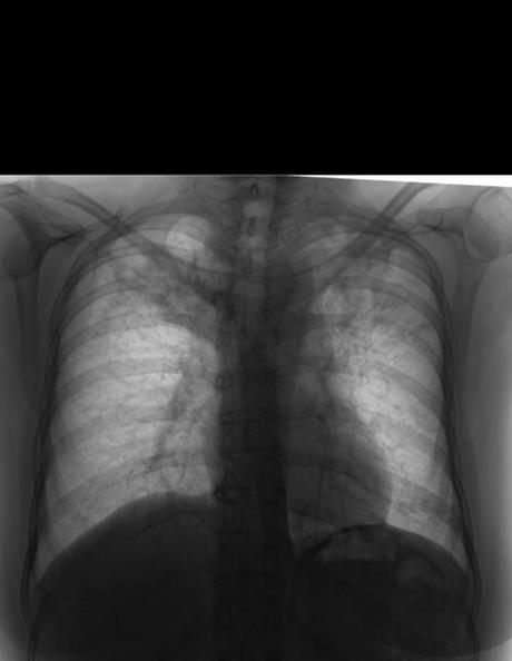 TUBERCULOSIS EN RECUPERACION