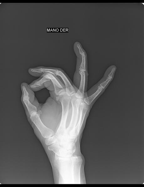 posible calcificación tendinosa vs avulsión cortical