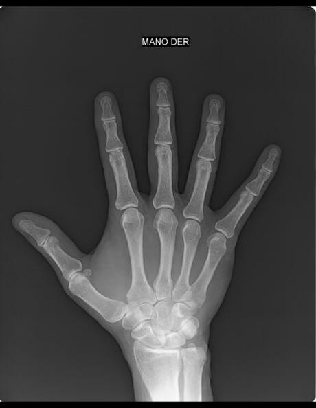 posible calcificación tendinosa vs avulsión cortical