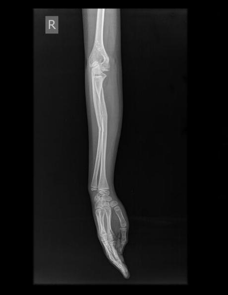 FRACTURA OBLICUA EN DIÁFISIS DE CÚBITO