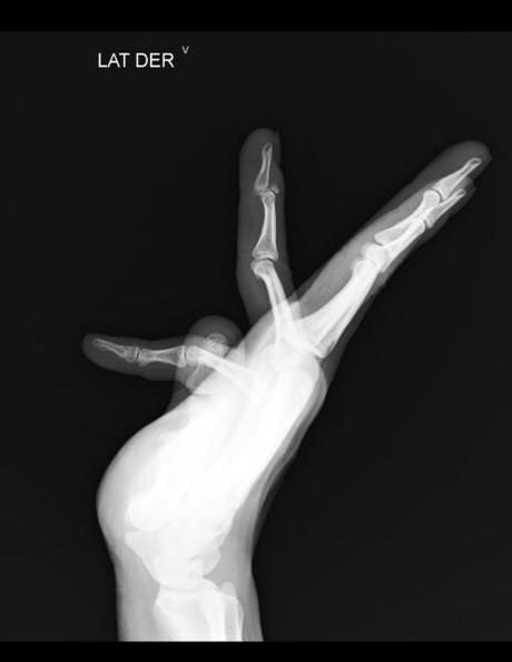 Fractura articular del segmento proximal de la falange distal del dedo anular