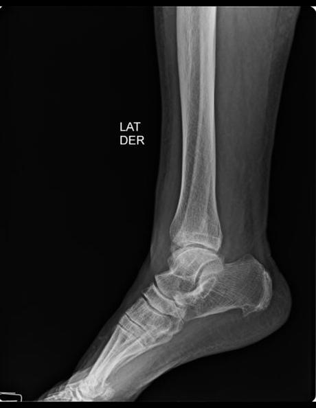 FRACTURA OBLICUA EN MALÉOLO LATERAL