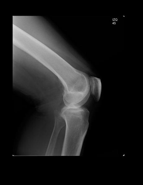 CONDROMALACIA PATELAR