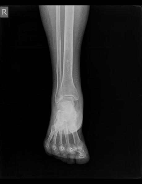 CALCIFICACIÓN DE LA ENTESIS DEL TENDÓN DE AQUILES