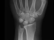 Fractura escafoides