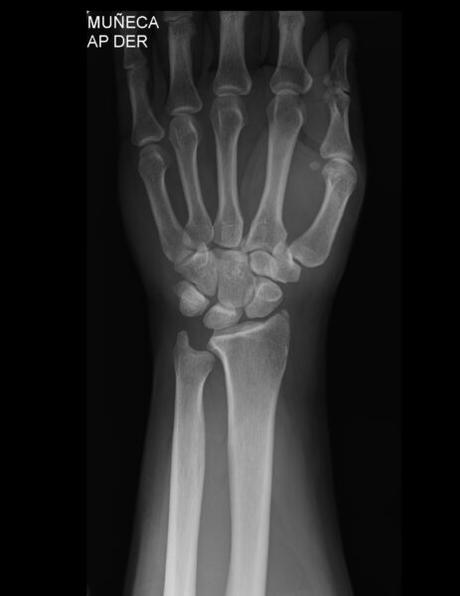FRACTURA DE ESCAFOIDES