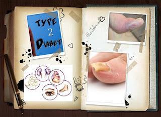 DEABETIS UNA ENFERMEDAD MUY TRAISIONERA