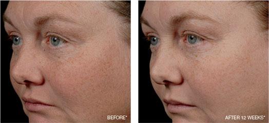 Strivectin ahora también contra las manchas cutáneas