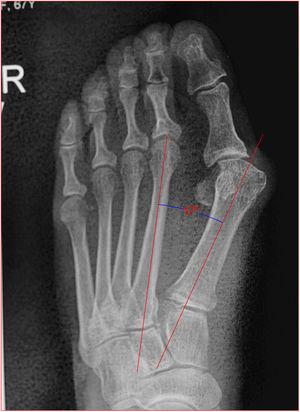 FRACTURA DE BASE DE 5TO METATARSIANO