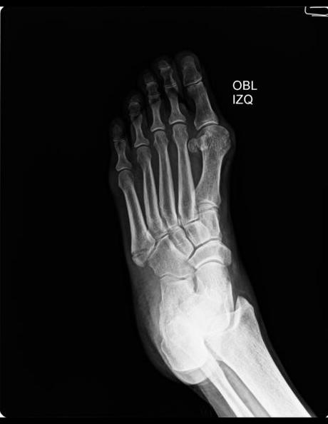 FRACTURA DE BASE DE 5TO METATARSIANO