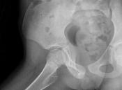 Coxa valga bilateral