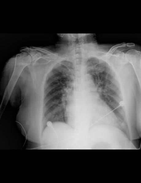 IMÁGENES SUGERENTES DE REDISTRIBUCIÓN VASCULAR