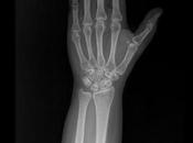 Fractura estiloides radio involucro intraarticular (fractura chofer)