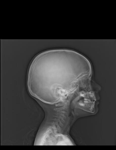 HIPERTROFIA AMIGDALINA MODERADA (GRADO II)