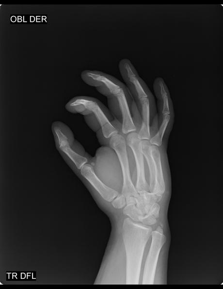 HUESO ACCESORIO OS TRIANGULARE (ENTRE APÓFISIS ESTILOIDES DEL CUBOIDES, HUESO PIRAMIDAL Y SEMILUNAR