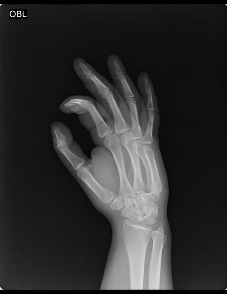 HUESO ACCESORIO OS TRIANGULARE (ENTRE APÓFISIS ESTILOIDES DEL CUBOIDES, HUESO PIRAMIDAL Y SEMILUNAR