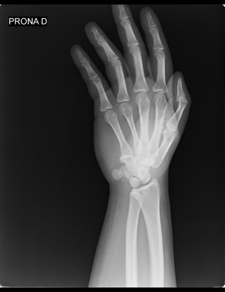 HUESO ACCESORIO OS TRIANGULARE (ENTRE APÓFISIS ESTILOIDES DEL CUBOIDES, HUESO PIRAMIDAL Y SEMILUNAR