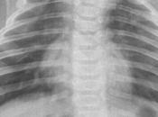 Proceso viral respiratorio, probablemente bronquiolitis