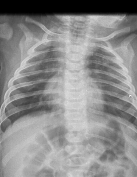 PROCESO VIRAL RESPIRATORIO, PROBABLEMENTE BRONQUIOLITIS