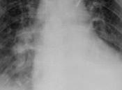 Neumopatía intersticial aguda