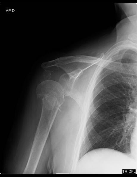 fractura del  cuello quirúrgico del húmero